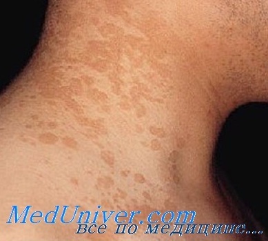 Pityriasis versicolor - diagnózis, kezelés