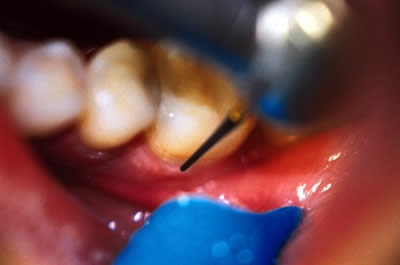 Șlefuirea și lustruirea dinților