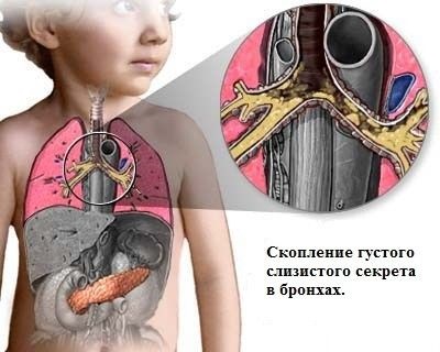 Pseudomonas aeruginosa - cauze, simptome și tratament