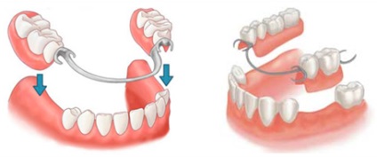 Stomatologie veche stomatologie dentară, proteză detașabilă