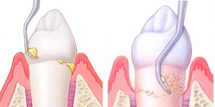 Eliminarea metodelor de curățare a tartrului