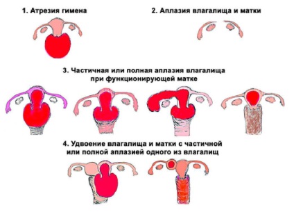 Tipuri de anomalii sexuale la femei - diagnosticarea anomaliilor organelor genitale feminine