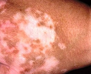 Tratamentul cu vitiligo de remedii folclorice la domiciliu