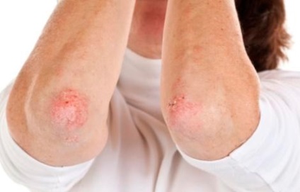 Totul despre eczemă și tratamentul acesteia