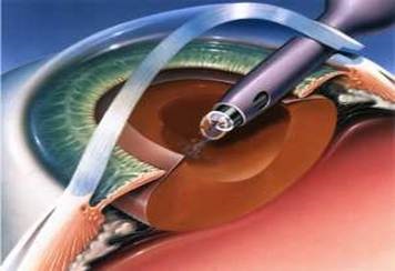 Tratamentul chirurgical al cataractei