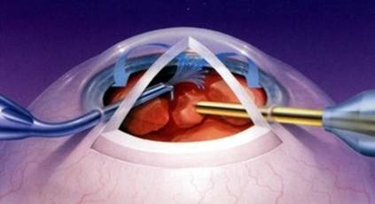 Tratamentul chirurgical al cataractei