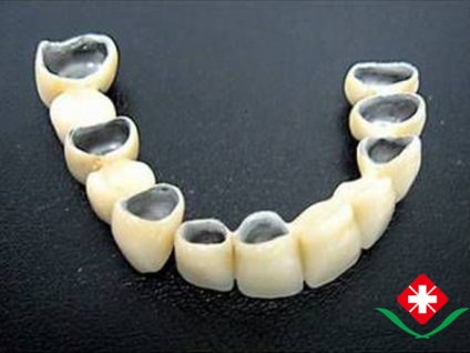 Japoneză ceramică metalică dentară, coroane din Japonia, proteze dentare