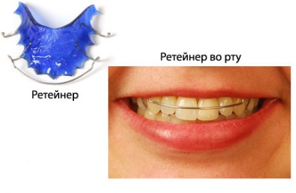 Malocclusion - áttekintés kezelés - orvosi portál EUROLAB