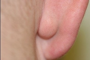 Ateromul din spatele urechii sau ateromul urechii cauzează simptome, tratament