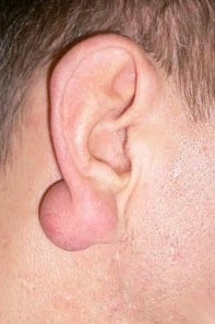 Ateromul din spatele urechii sau ateromul urechii cauzează simptome, tratament