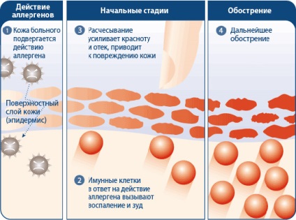 Dermatita atopica intr-o dieta si nutritie hipoalergenica care alapteaza mama