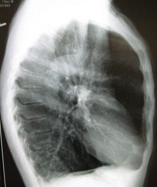 Hordó-alakú mellkas és a tüdőemfizéma