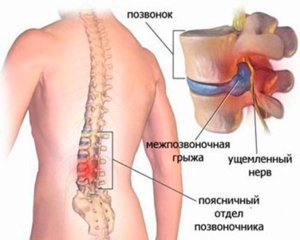 Fájdalom a bordák alatt húzódó, hogy a hátsó -, hogy miért van, és hogyan kell harcolni