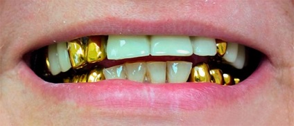 Ceea ce este periculos sunt coroanele ștampilate în cavitatea bucală, clinica de stomatologie estetică de către interstom