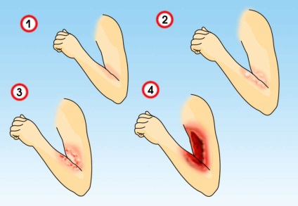 Ce trebuie să faci cu un arsură, portalul de informații al ucrainei
