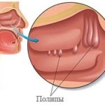 Ce este metrita uterului - cauzele, simptomele, tratamentul