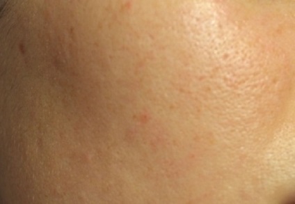 Minerit tencuiala de piele de origine coreeană probleme cu probleme la fața locului patch-uri clar
