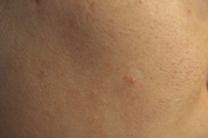 Minerit tencuiala de piele de origine coreeană probleme cu probleme la fața locului patch-uri clar