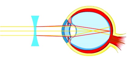 Hyperopia (hiperopie)