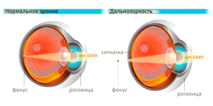 Hyperopia (hiperopie)