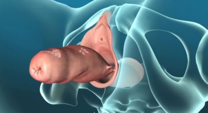 Alungirea colului uterin ceea ce este, operația