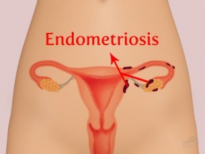 Endometriózis tünetei, hogyan kell kezelni