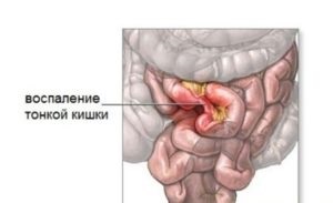 Simptomele enteritei, diagnosticul și tratamentul patologiei