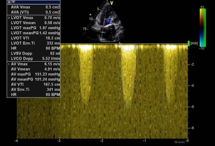 Echocardiografia pentru manechine, partea 6