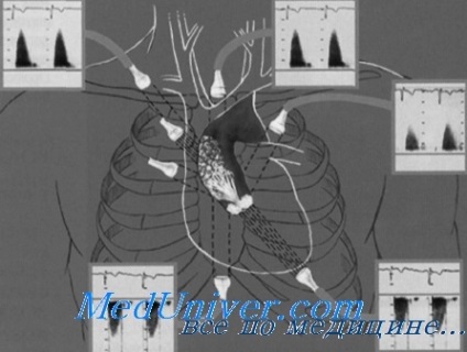 Echocardiografia în cazul stenozei severe aortice