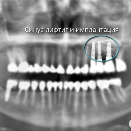 Fotografii înainte și după vizitarea stomatologiei profesoriale - secolul 22, tratamentul stomatologic galerie foto,