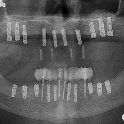 Fotografii înainte și după vizitarea stomatologiei profesoriale - secolul 22, tratamentul stomatologic galerie foto,