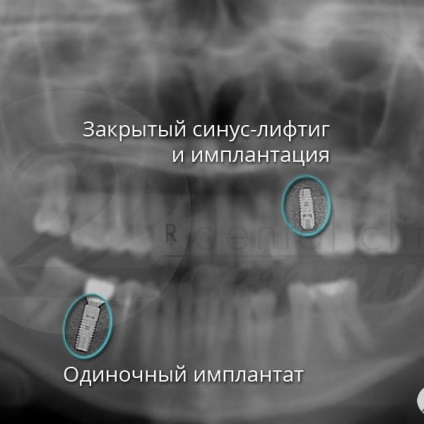 Fotografii înainte și după vizitarea stomatologiei profesoriale - secolul 22, tratamentul stomatologic galerie foto,