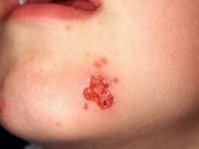 Herpesul pe bărbie - simptome și tratament, fotografie