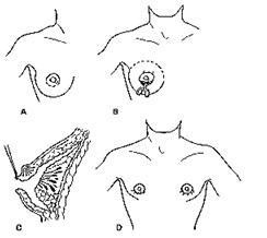 Gynecomastia szövetségi állami költségvetési intézmény.