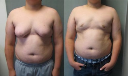 Gynecomastia - mts bios, centru medical bios clinica 1 min - metrou, 10 min - metrou