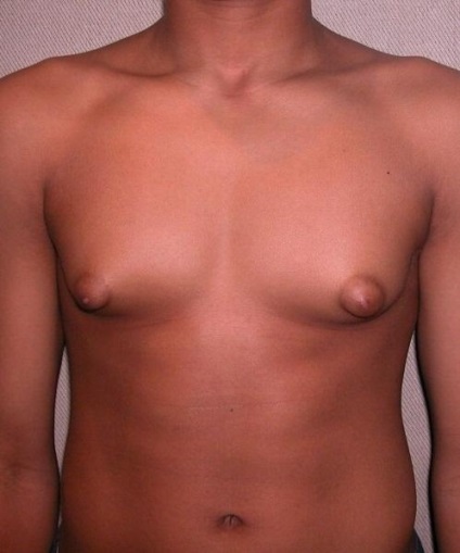 Gynecomastia - mts bios, centru medical bios clinica 1 min - metrou, 10 min - metrou