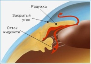 Glaucomul factorilor de dezvoltare, etapele, simptomele