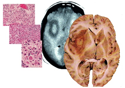 Glioblastomul - tratamentul tumorii cerebrale, prognosticul, extinderea și speranța de viață