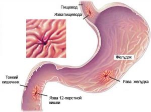 Tratamentul homeopatic al ulcerului peptic al stomacului și al duodenului