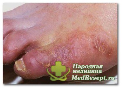 Ciuperca piciorului - o boală insidioasă cu consecințe neplăcute