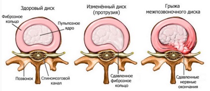 Hernia coloanei vertebrale toracice, simptome și tratament, cauze de patologie