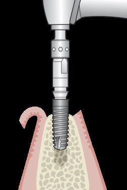 Implant Ankylos (ankylosis) ár