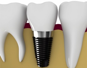 Implantarea de plusuri și minusuri din dinți, plusuri și minusuri