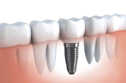 Implantarea de plusuri și minusuri din dinți, plusuri și minusuri