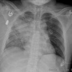 Infarctul pulmonar - jurnal medical