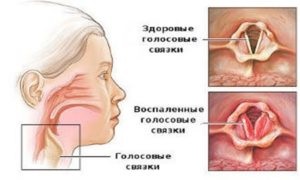 Inhalarea cu nebulizator de laringotraheită, medicamente