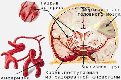 Stroke, su-jok de formare, su-jok diagnostic, su-jok terapie