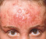 Inversă acnee - cauze, simptome, diagnostic și tratament