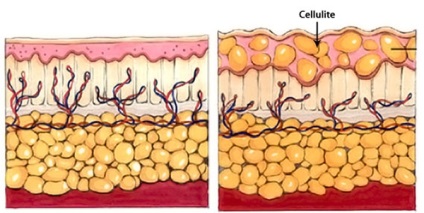 Din cauza a ceea ce există o celulită și cum să scapi de ea