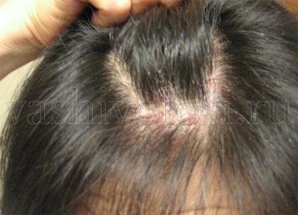 Cum să tratați psoriazisul pe cap, tratamentul, părul